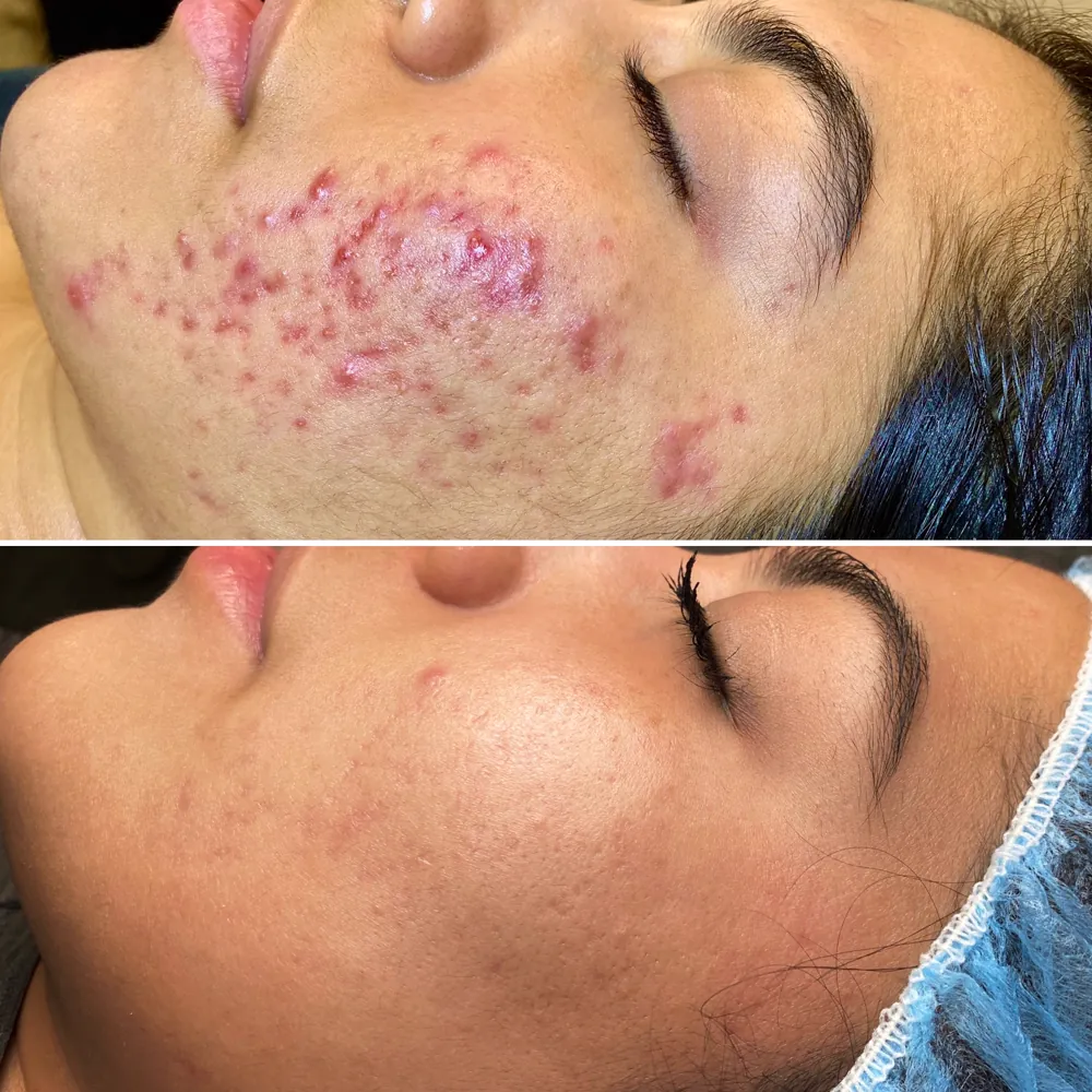 Лечение акне до и после — лицо, методика PRO-ACNE