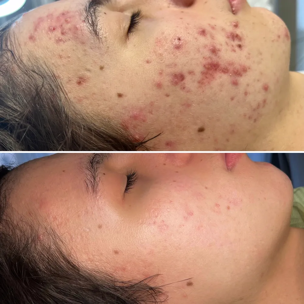 Лечение акне до и после — лицо, методика PRO-ACNE