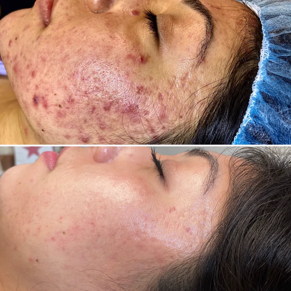 Лечение акне до и после — лицо, методика PRO-ACNE