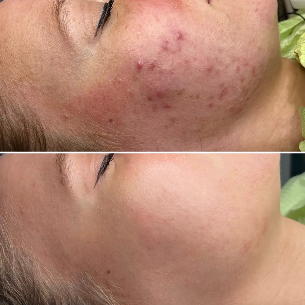 Лечение акне до и после — лицо, методика PRO-ACNE