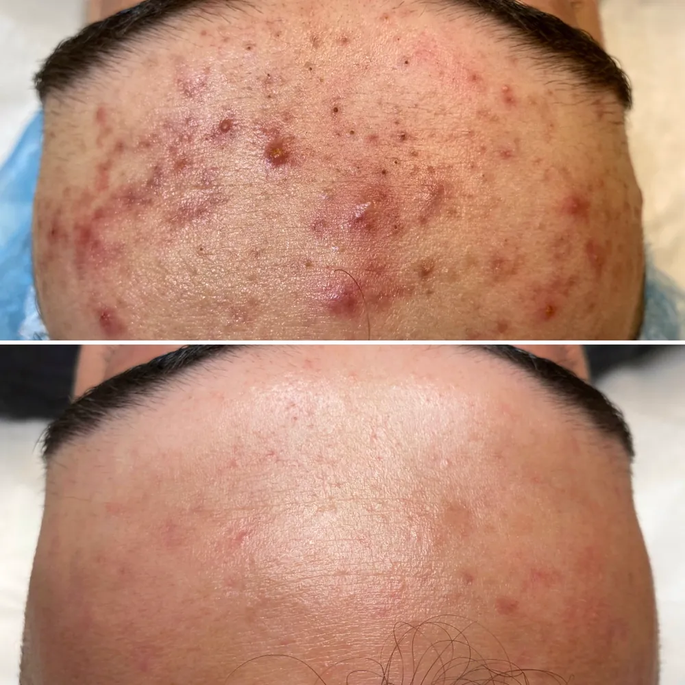 Акне на лбу до и после — методика PRO-ACNE