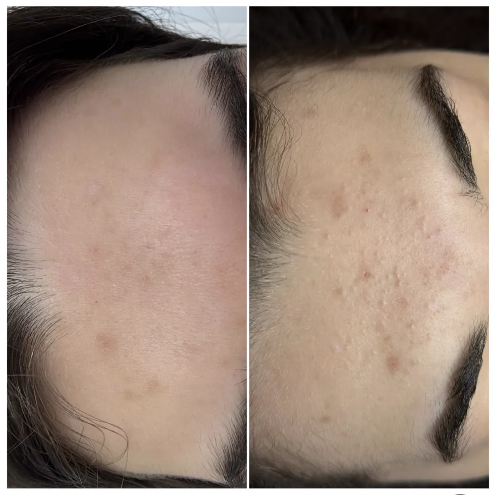 Акне на лбу до и после — методика PRO-ACNE