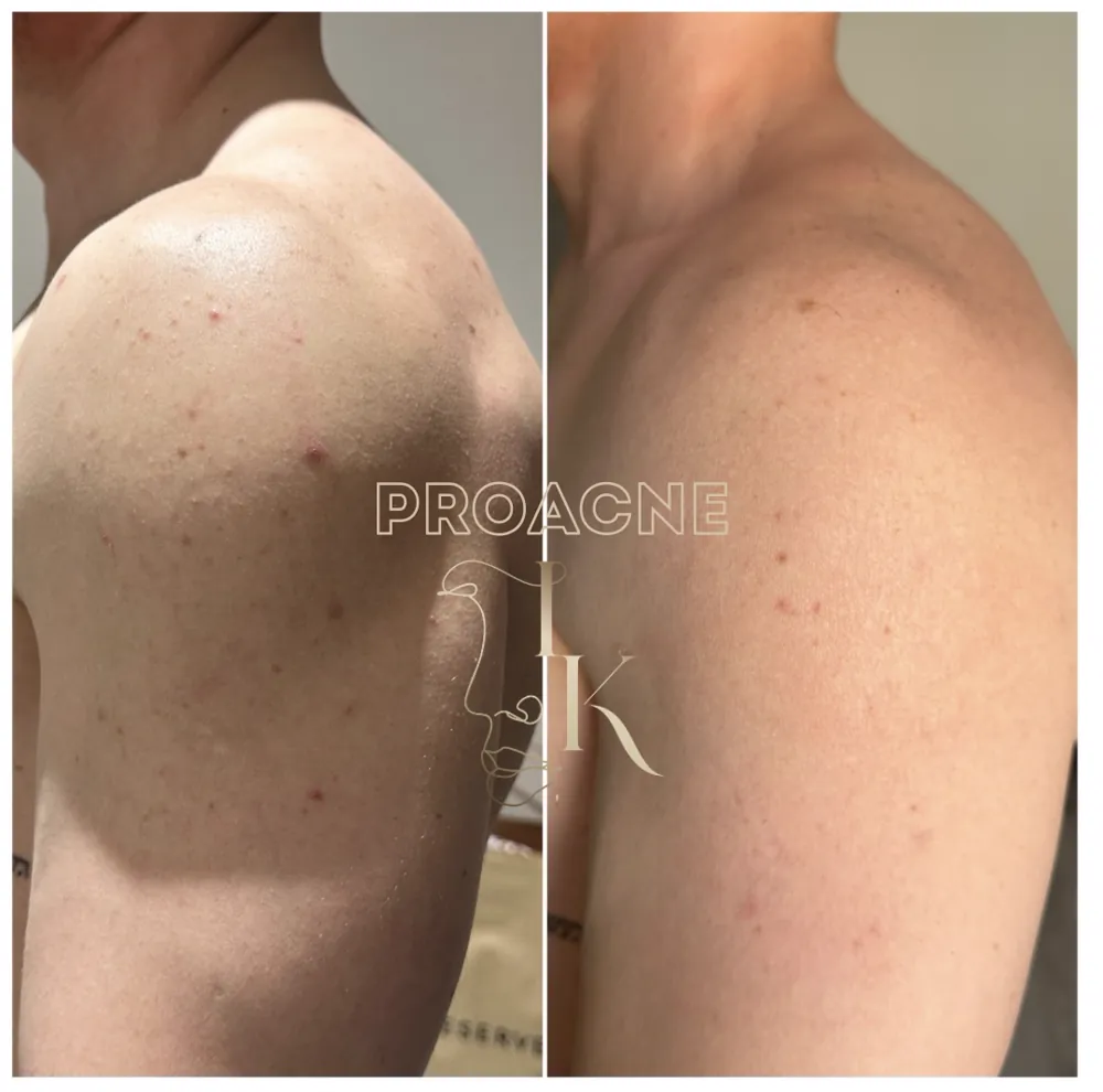 Акне на плечах до и после — методика PRO-ACNE