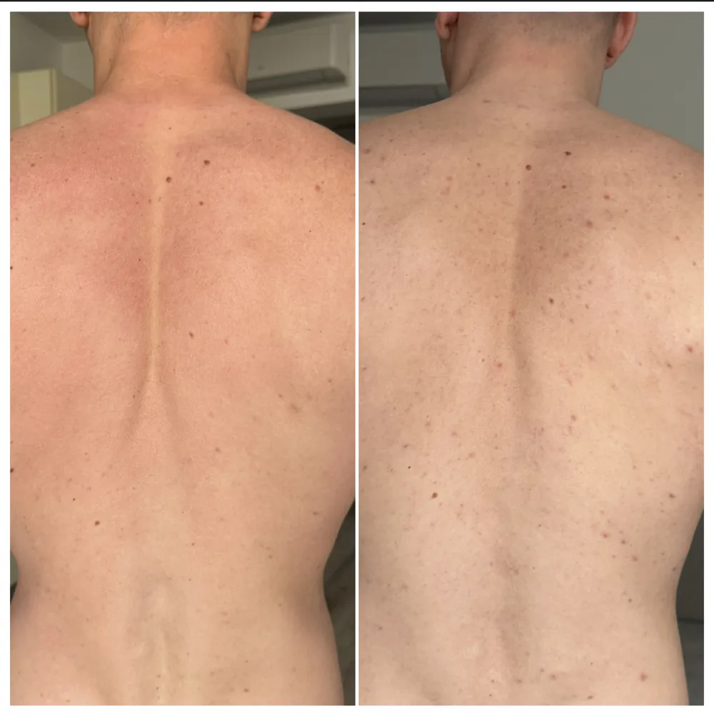 Акне на спине до и после — методика PRO-ACNE