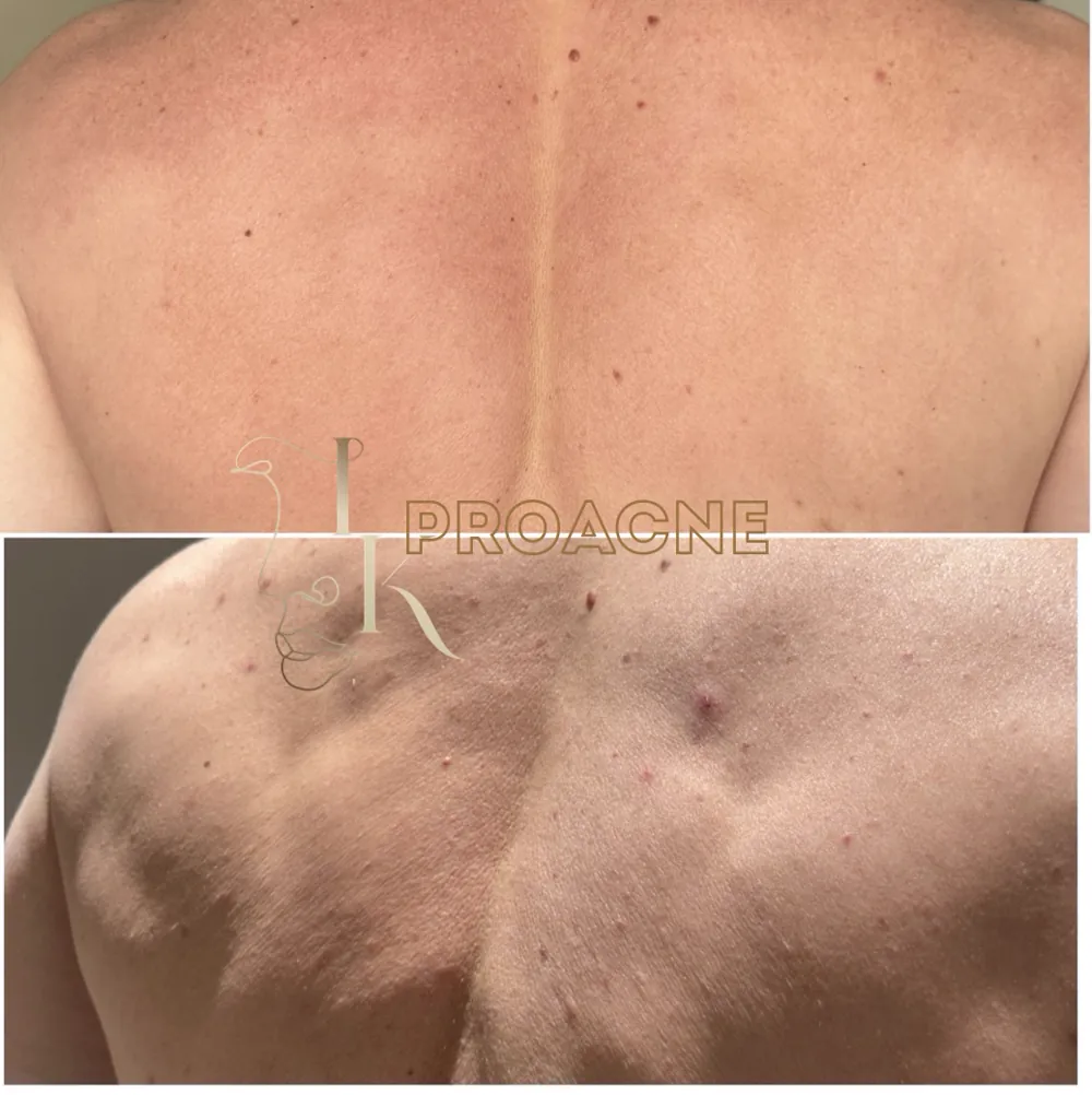 Акне на спине и плечах до и после — методика PRO-ACNE