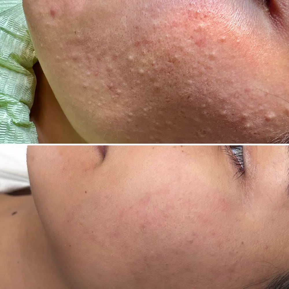 Лечение постакне и текстуры до и после — PRO-ACNE