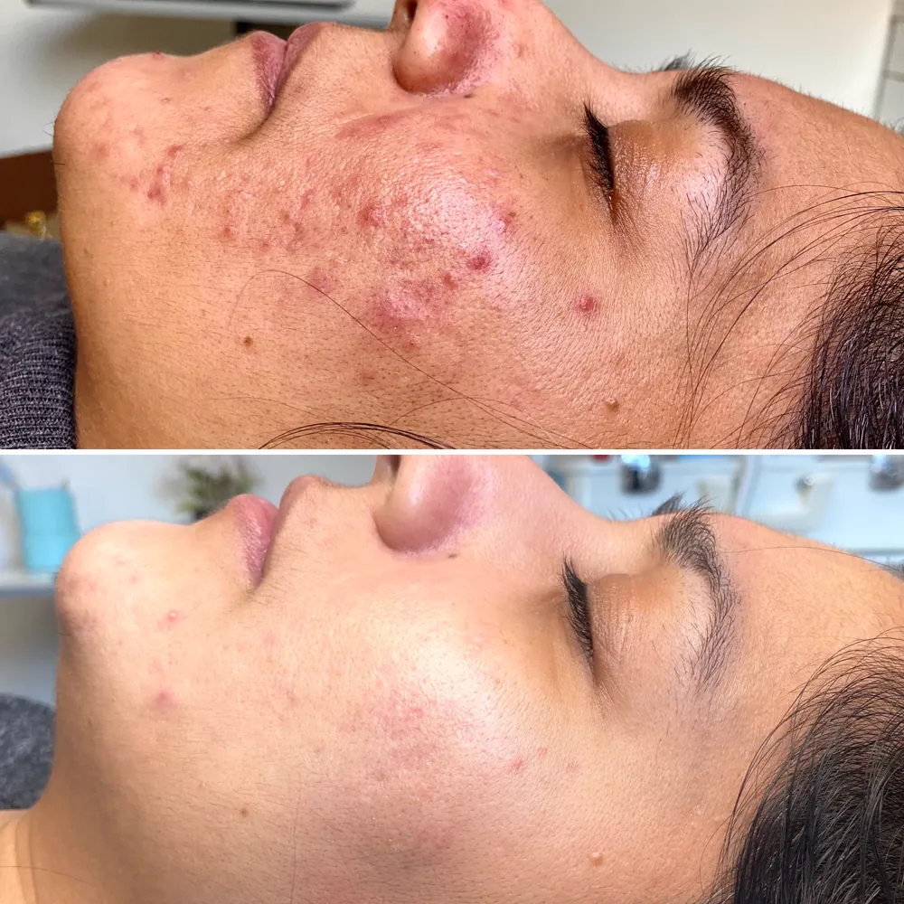 Лечение постакне и текстуры до и после — PRO-ACNE