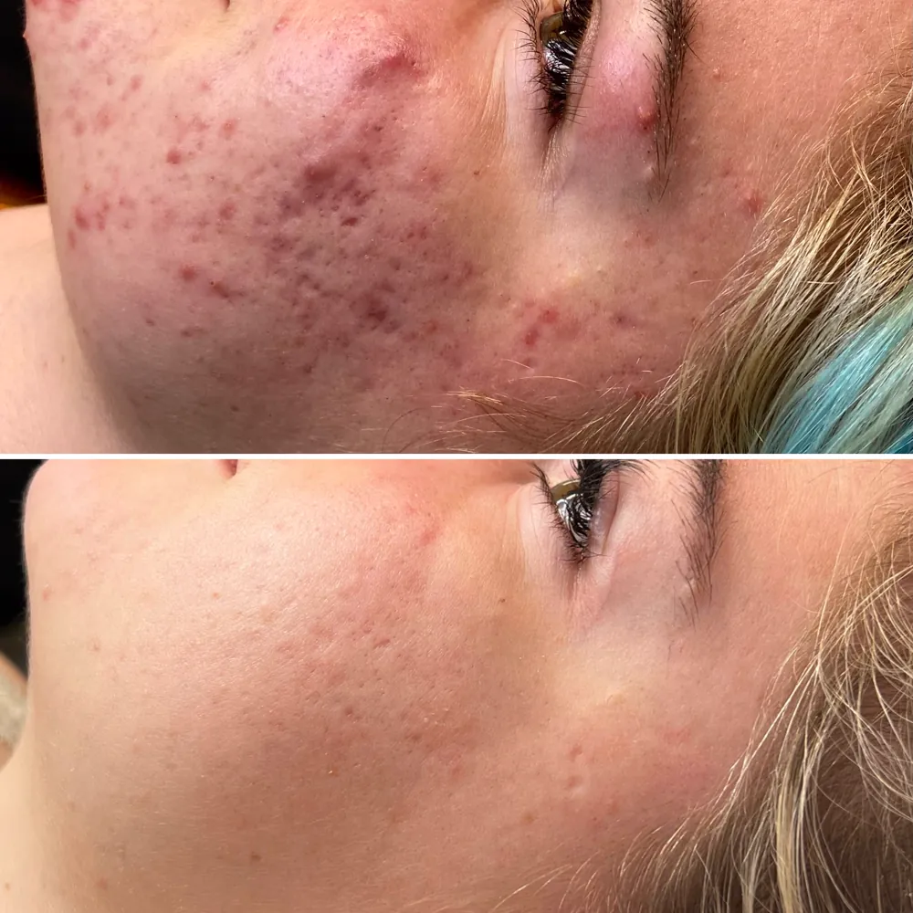 Лечение постакне и текстуры до и после — PRO-ACNE
